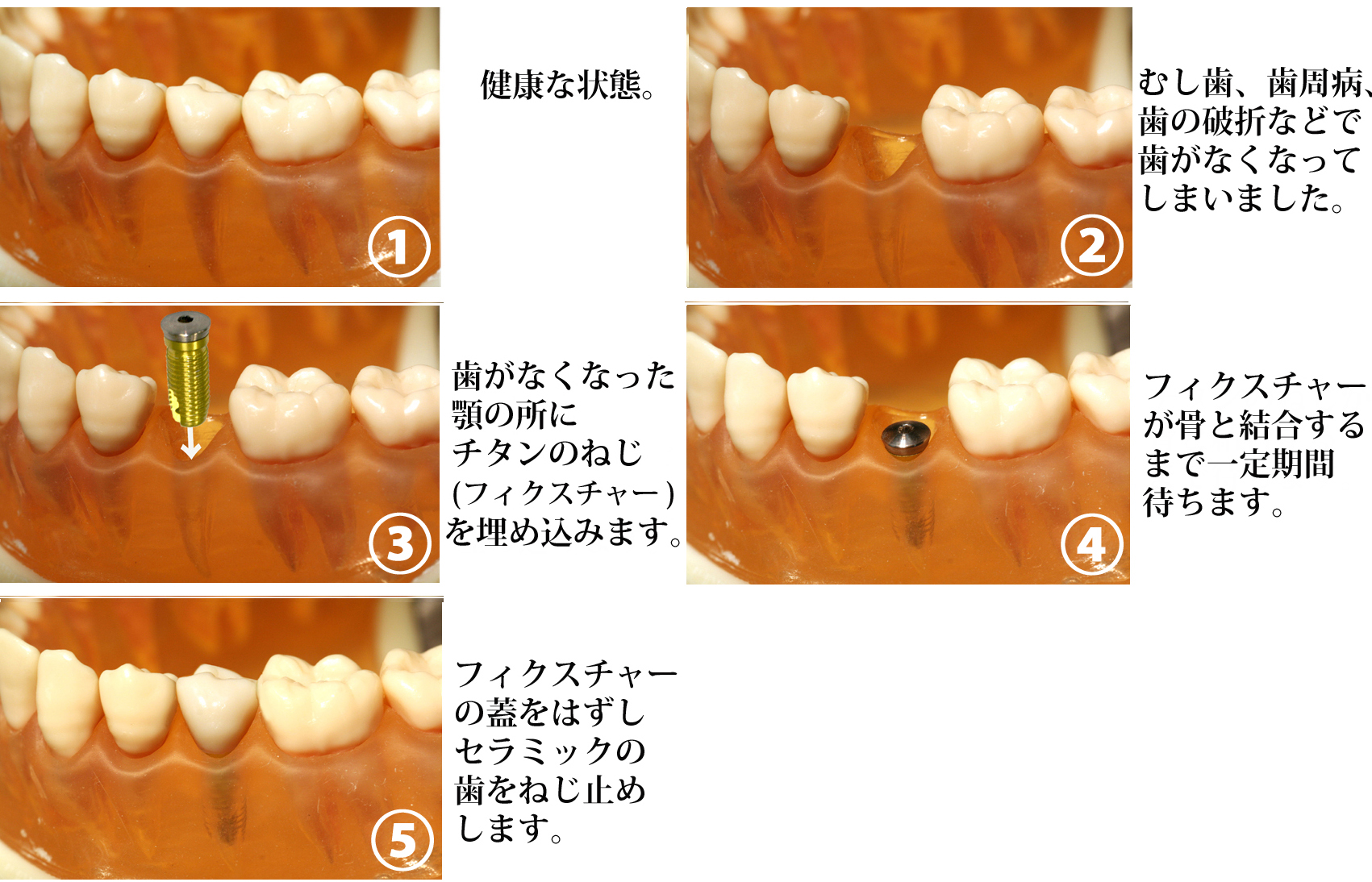 葛飾区立石・青戸 高見歯科のインプラント治療、治療費