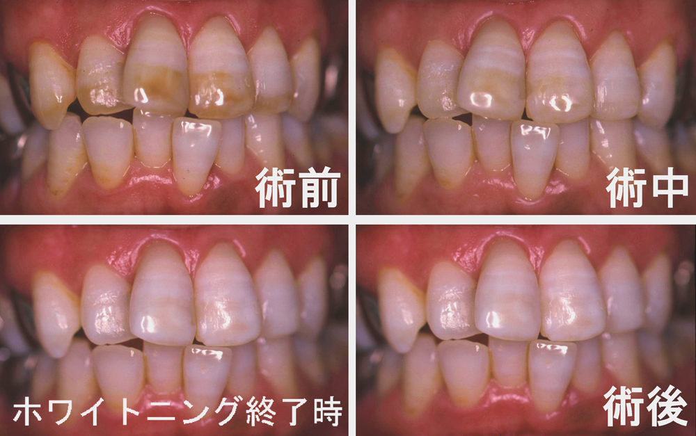 葛飾区高見歯科クリニックのホワイトニング写真４