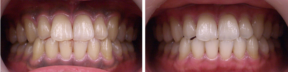葛飾区高見歯科クリニックのホワイトニング写真３
